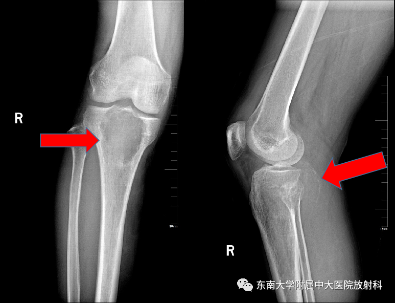 影像PPT - 【PPT】骨巨细胞瘤-1