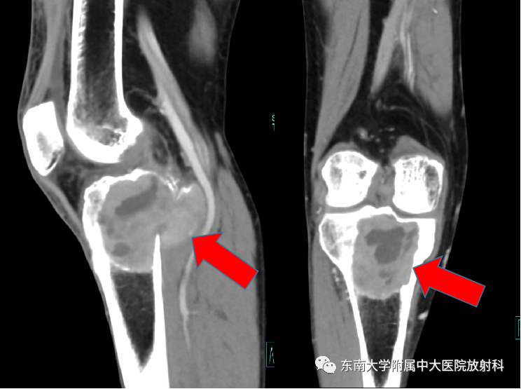 影像PPT - 【PPT】骨巨细胞瘤-2