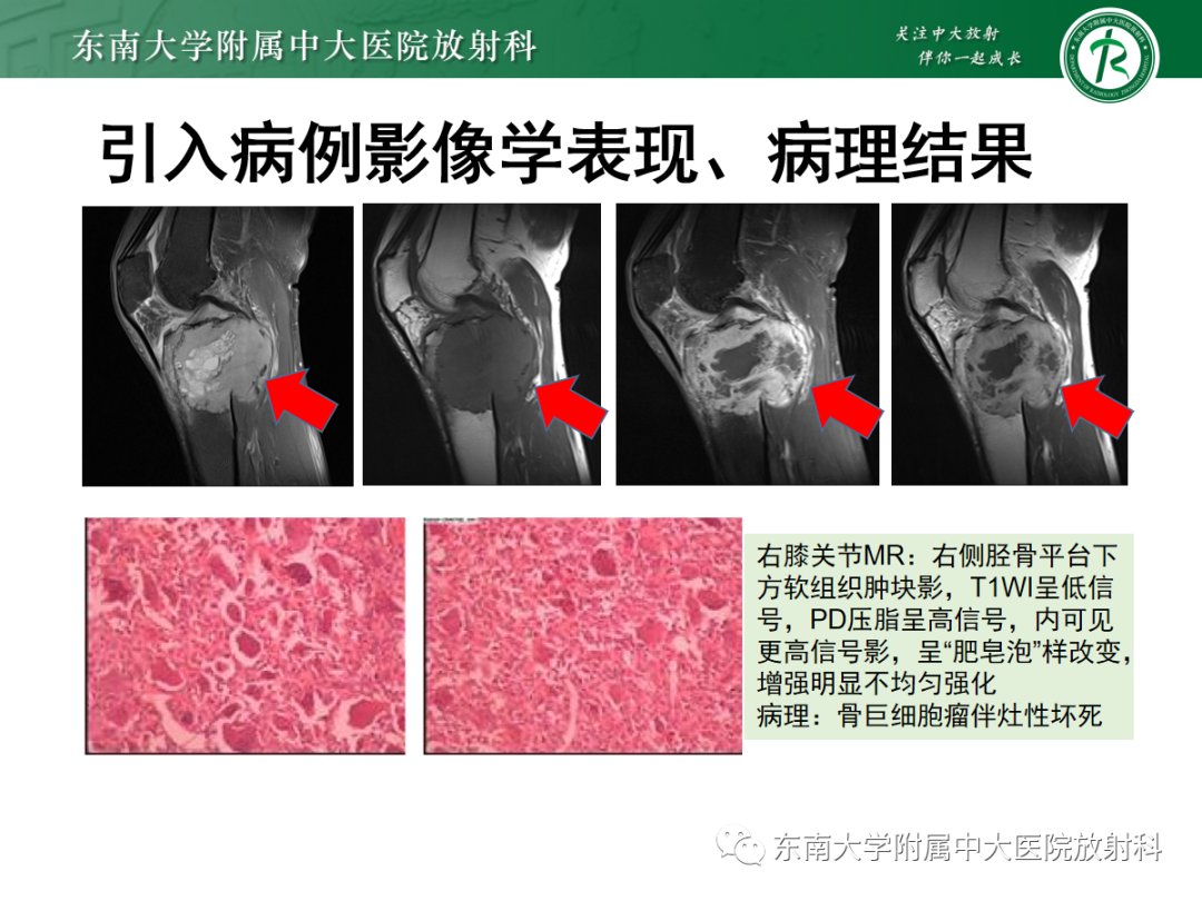 影像PPT - 【PPT】骨巨细胞瘤-4