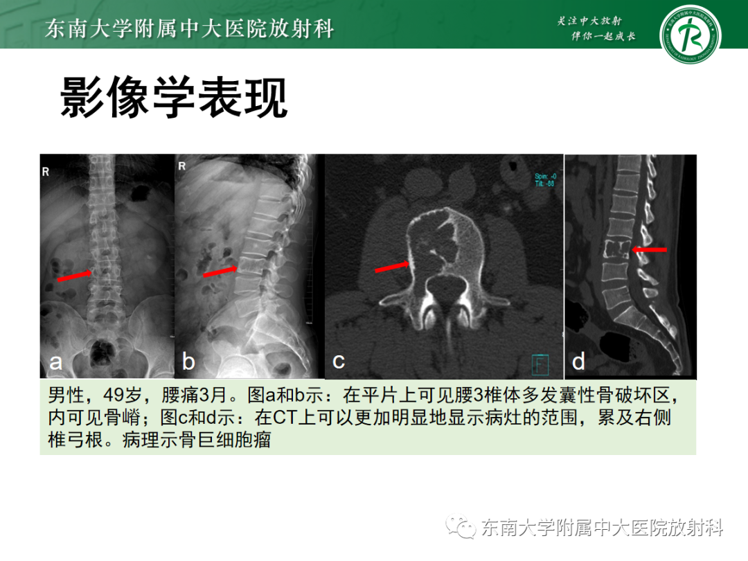 影像PPT - 【PPT】骨巨细胞瘤-13