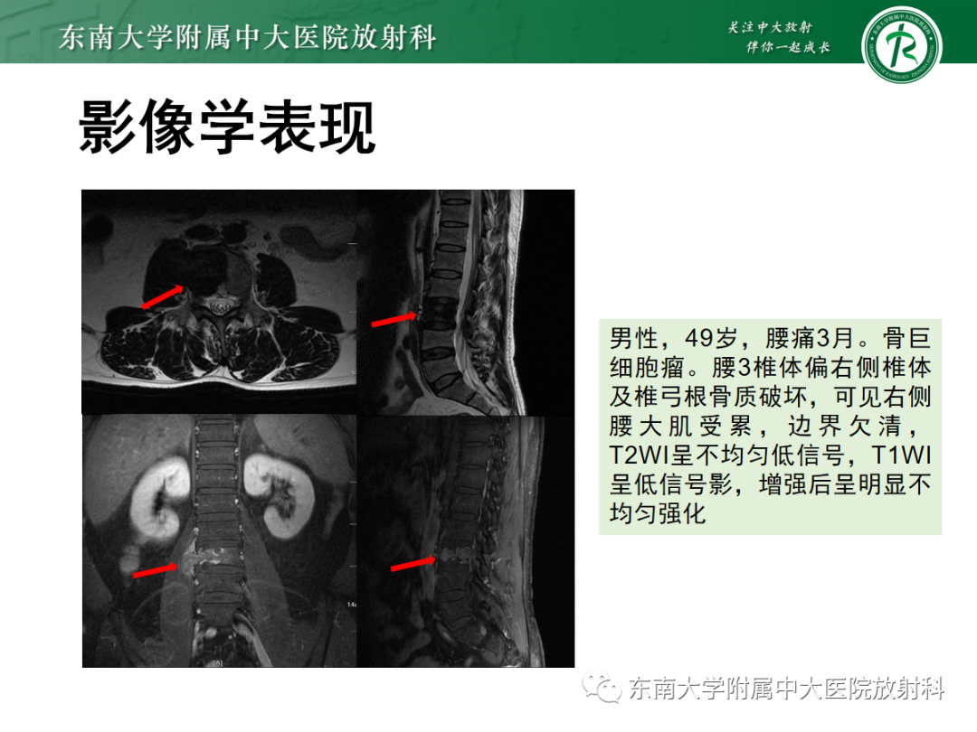 影像PPT - 【PPT】骨巨细胞瘤-14