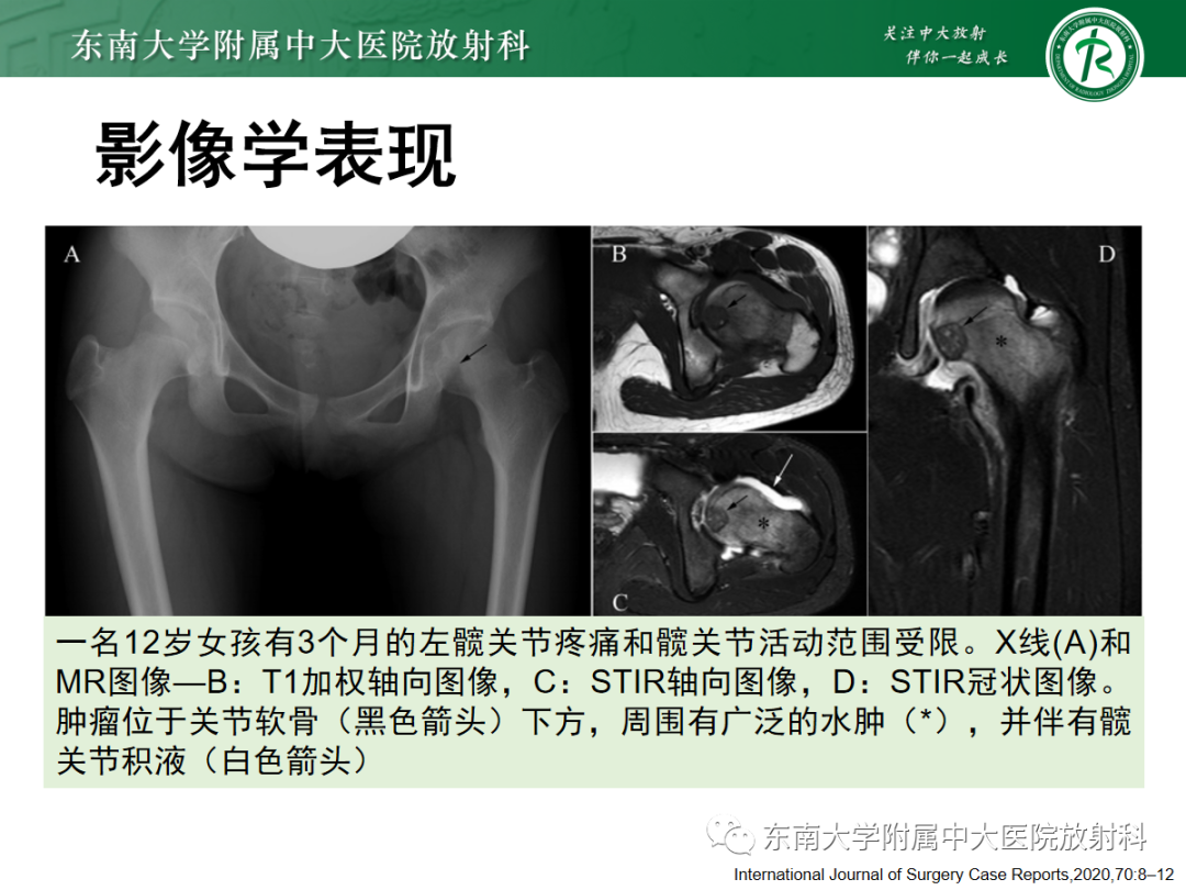 影像PPT - 【PPT】骨巨细胞瘤-19