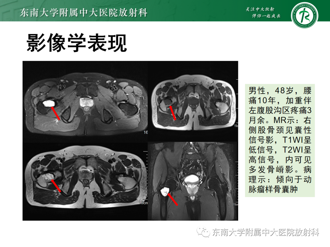 影像PPT - 【PPT】骨巨细胞瘤-21