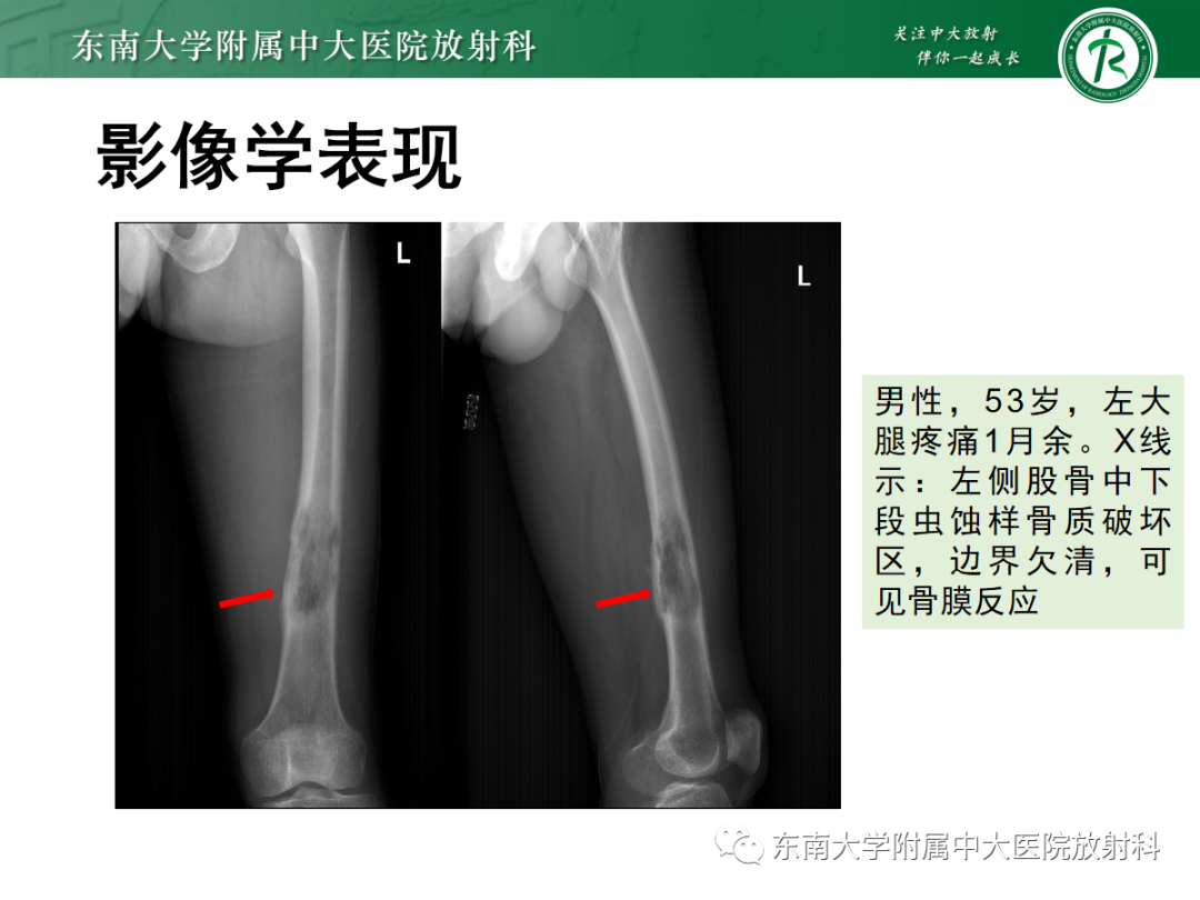 影像PPT - 【PPT】骨巨细胞瘤-26