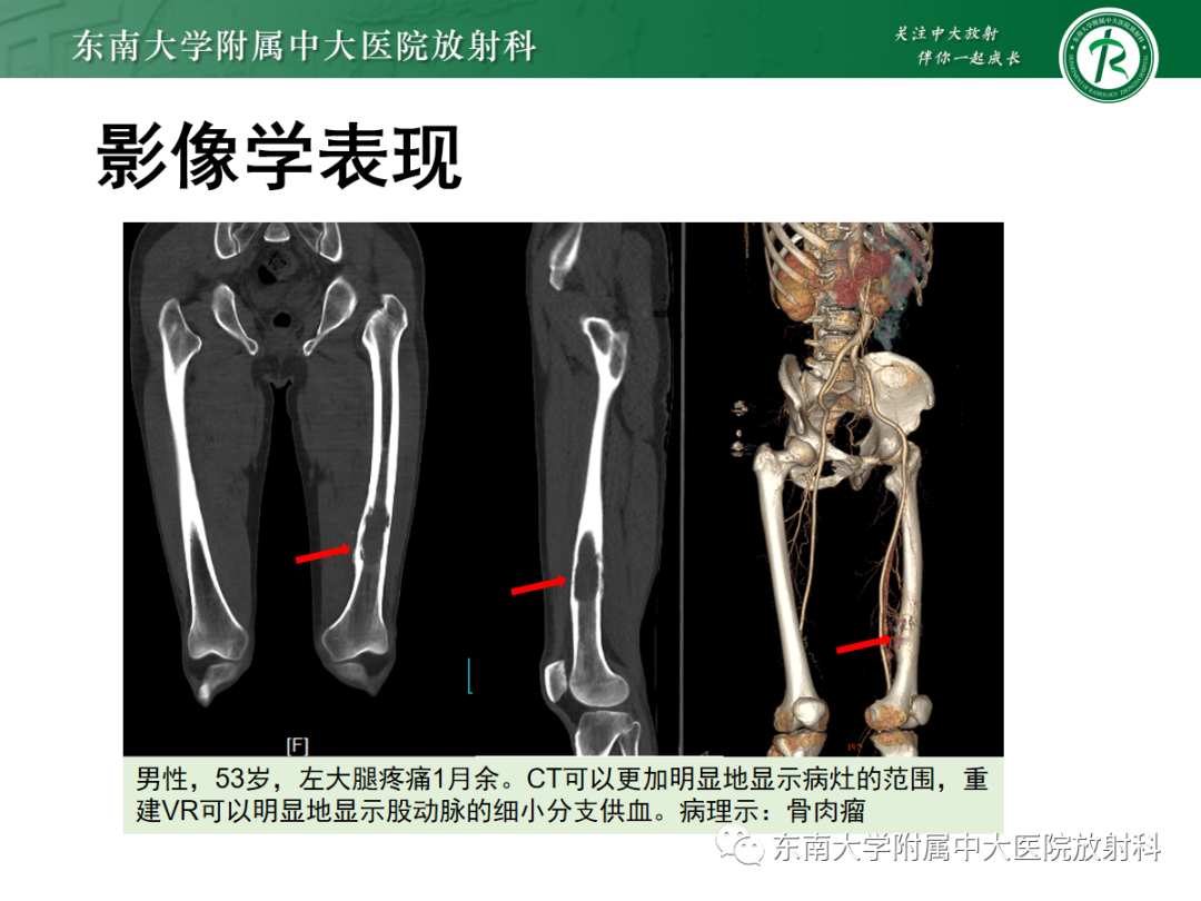 影像PPT - 【PPT】骨巨细胞瘤-27