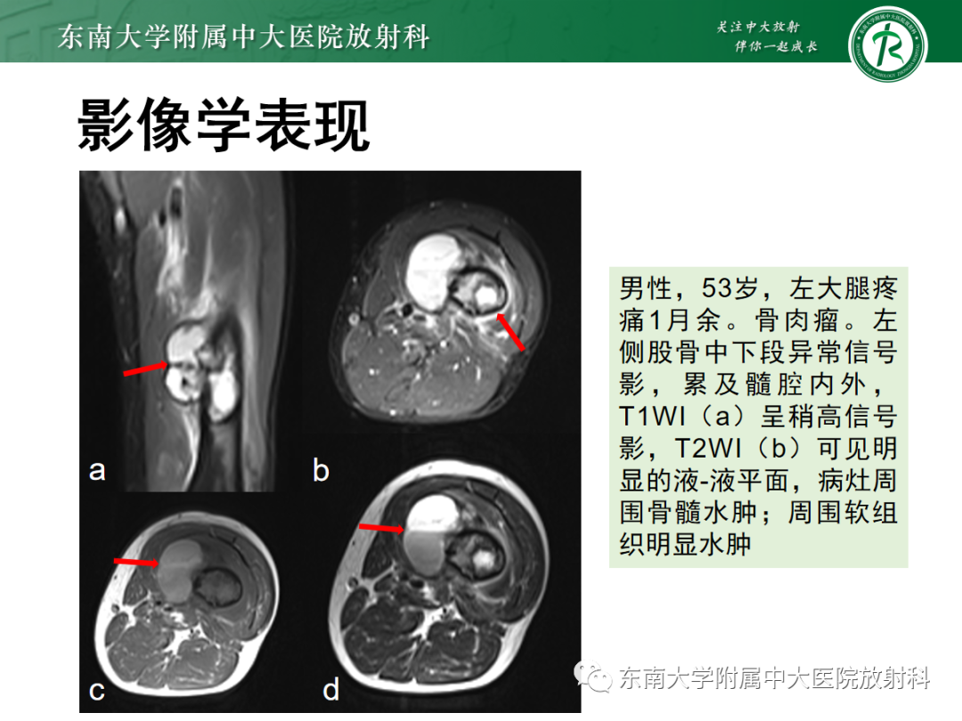 影像PPT - 【PPT】骨巨细胞瘤-28