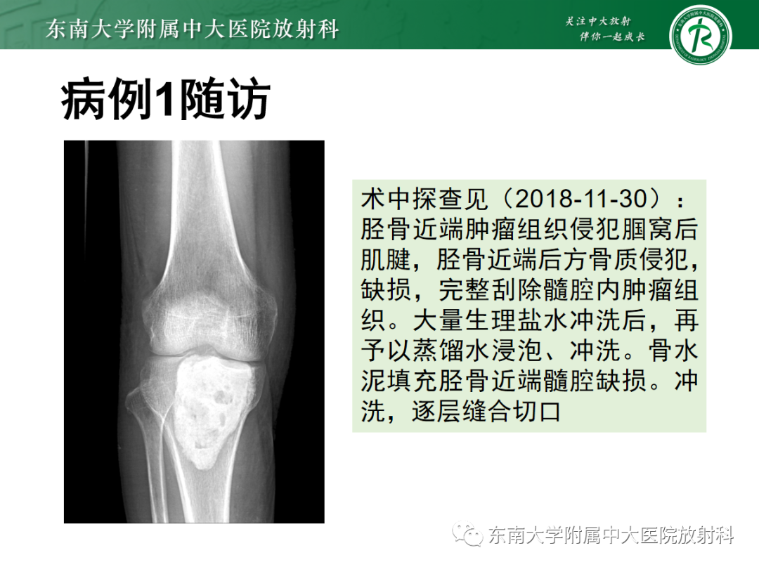 影像PPT - 【PPT】骨巨细胞瘤-32