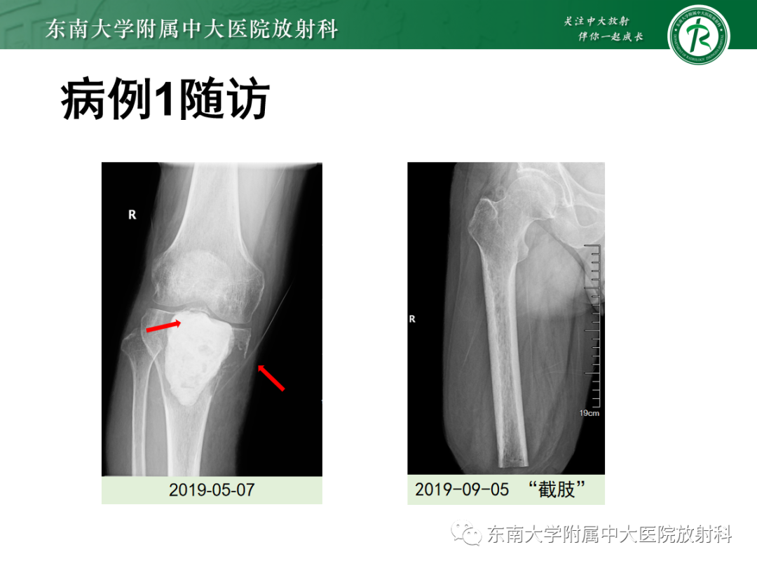影像PPT - 【PPT】骨巨细胞瘤-33