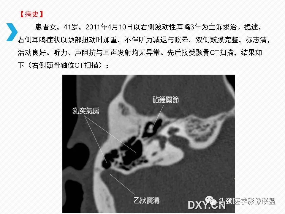 影像PPT - 【PPT】乙状窦憩室再认识-2
