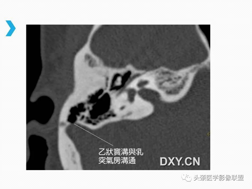 影像PPT - 【PPT】乙状窦憩室再认识-3