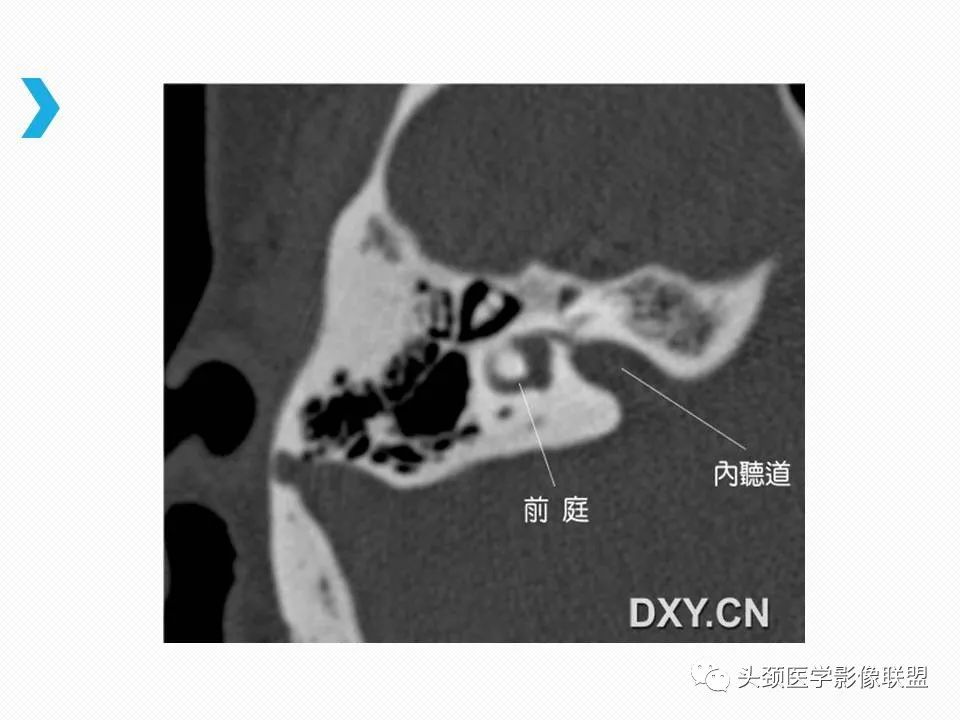 影像PPT - 【PPT】乙状窦憩室再认识-5