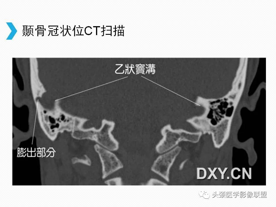 影像PPT - 【PPT】乙状窦憩室再认识-7