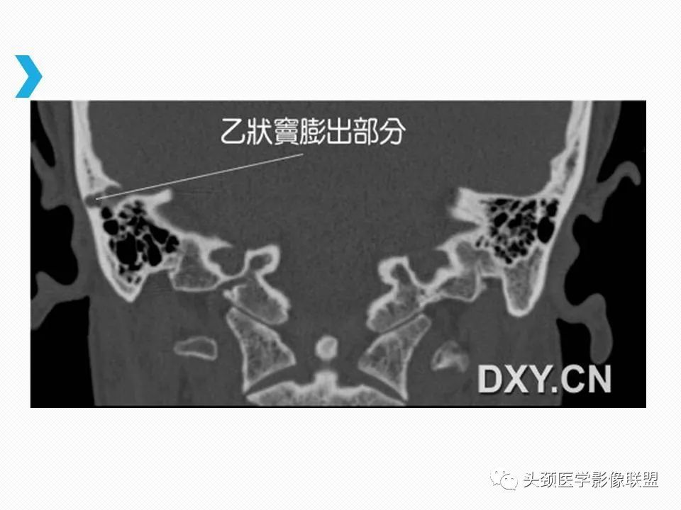 影像PPT - 【PPT】乙状窦憩室再认识-9