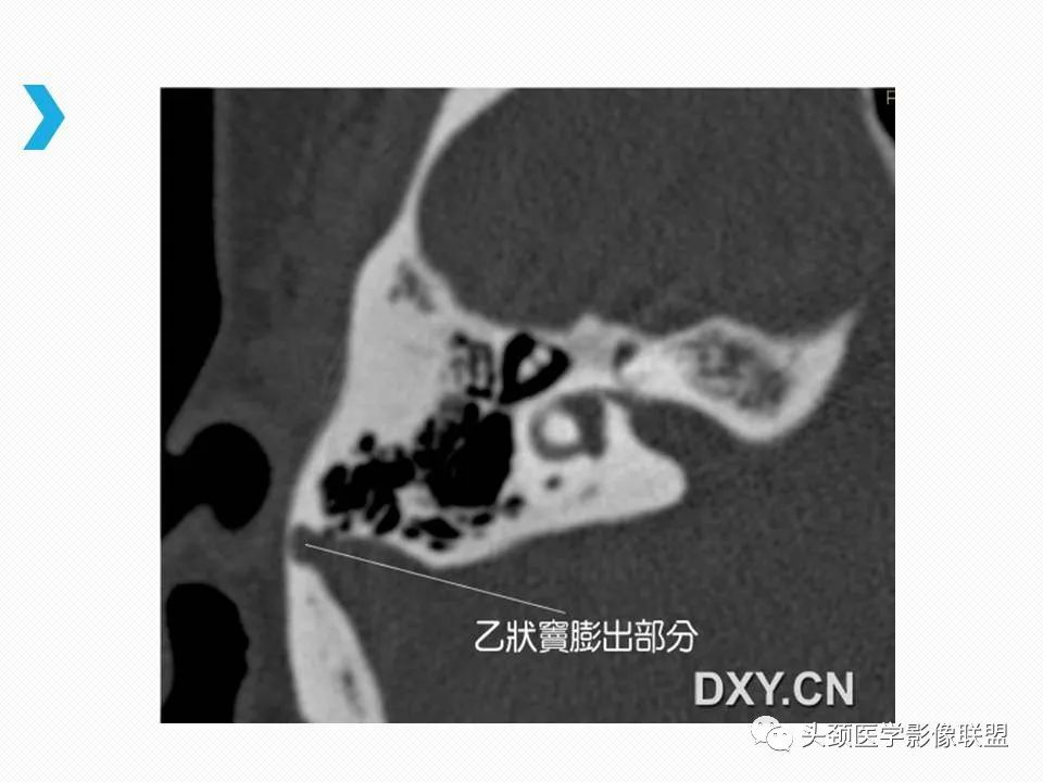 影像PPT - 【PPT】乙状窦憩室再认识-6