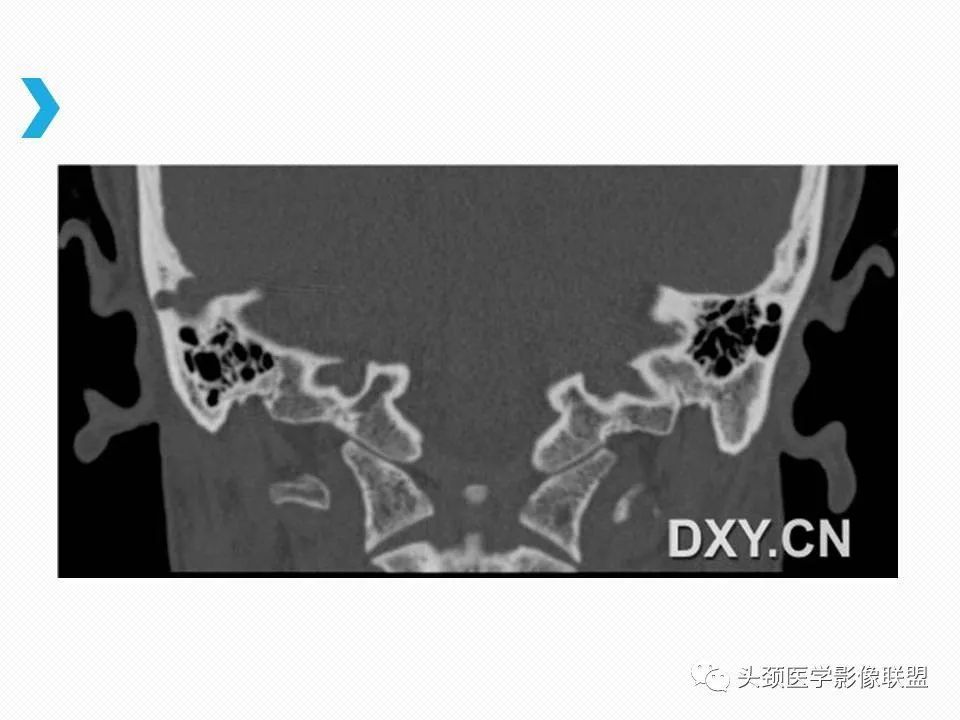 影像PPT - 【PPT】乙状窦憩室再认识-8