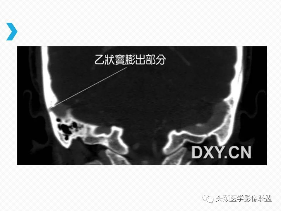 影像PPT - 【PPT】乙状窦憩室再认识-11