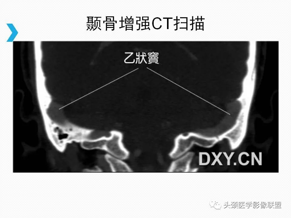 影像PPT - 【PPT】乙状窦憩室再认识-10