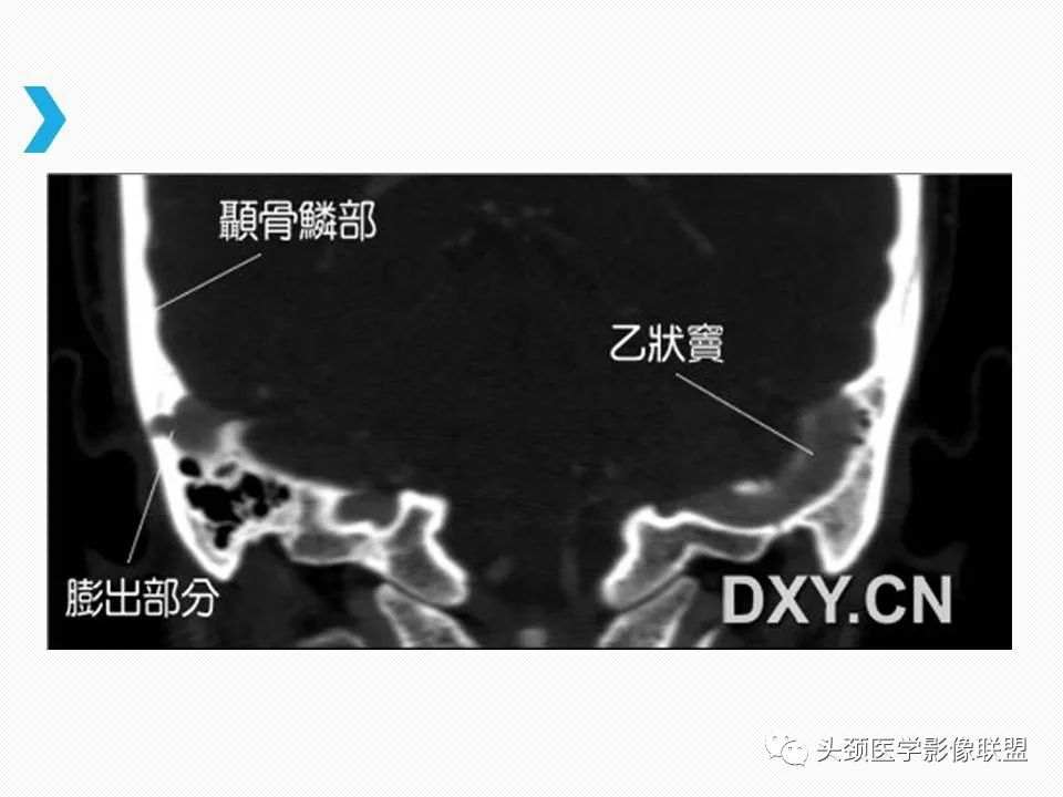 影像PPT - 【PPT】乙状窦憩室再认识-12
