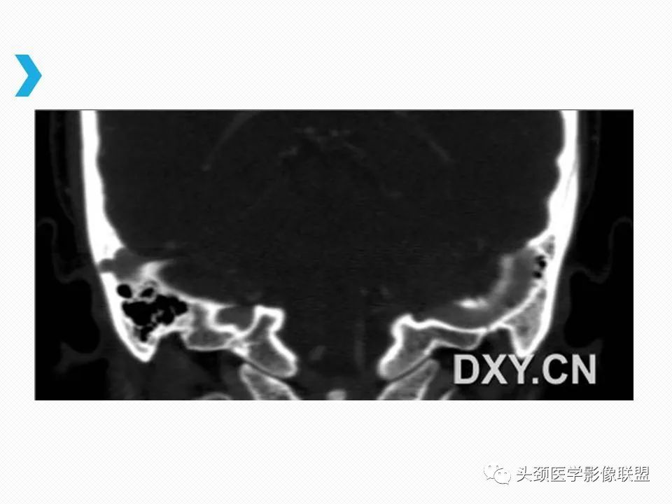 影像PPT - 【PPT】乙状窦憩室再认识-13