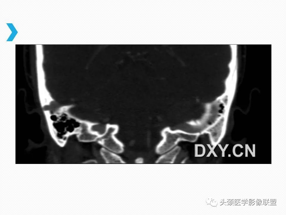 影像PPT - 【PPT】乙状窦憩室再认识-14