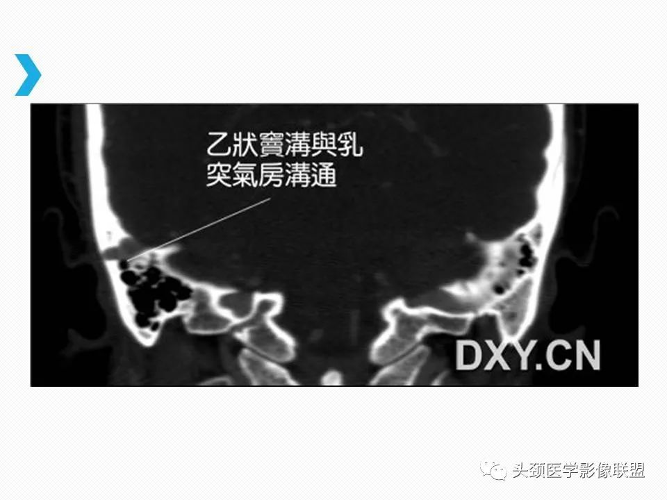影像PPT - 【PPT】乙状窦憩室再认识-15