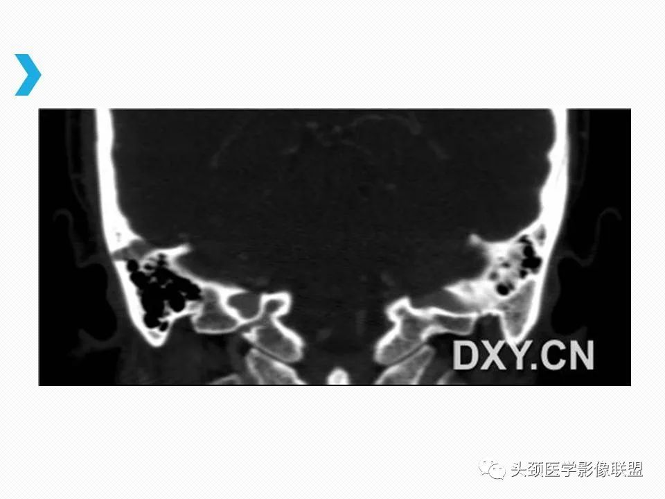 影像PPT - 【PPT】乙状窦憩室再认识-16