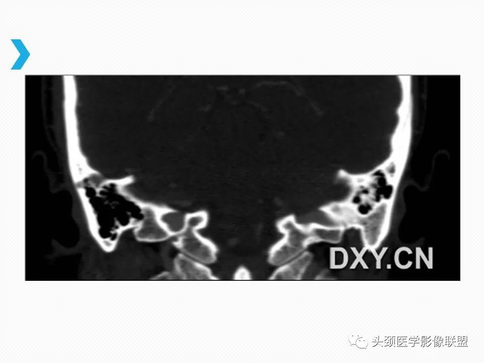 影像PPT - 【PPT】乙状窦憩室再认识-17