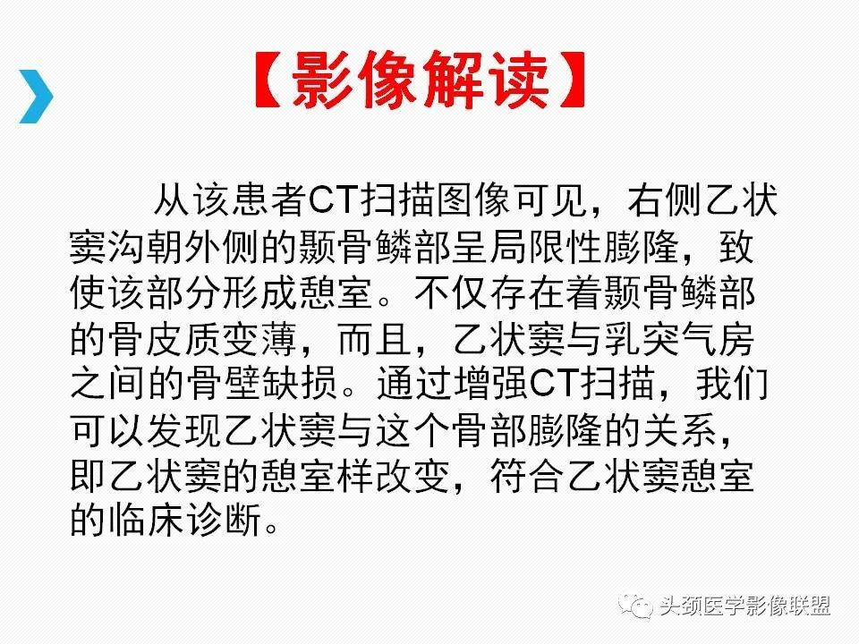 影像PPT - 【PPT】乙状窦憩室再认识-18