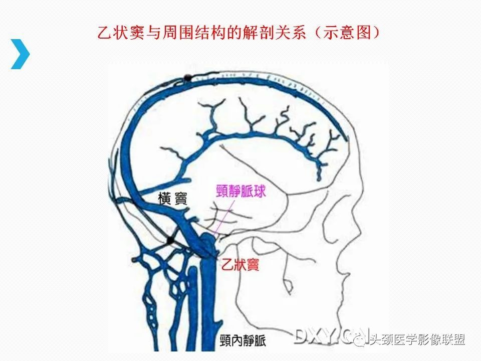 影像PPT - 【PPT】乙状窦憩室再认识-21