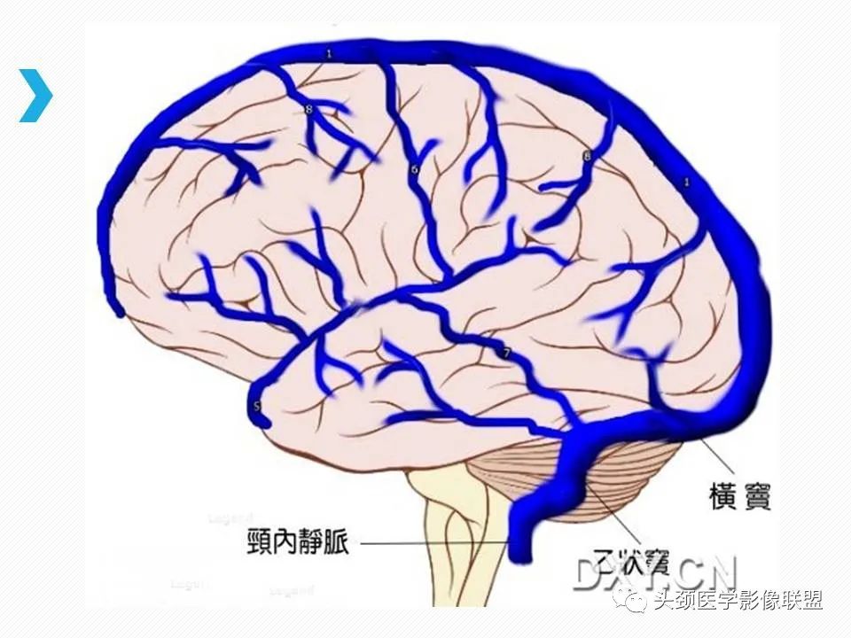 影像PPT - 【PPT】乙状窦憩室再认识-22