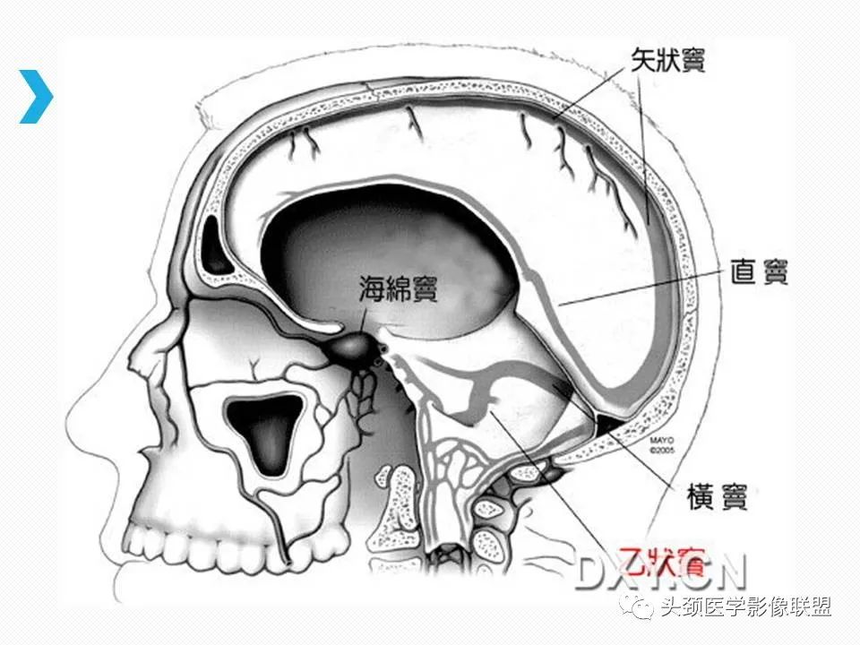 影像PPT - 【PPT】乙状窦憩室再认识-23