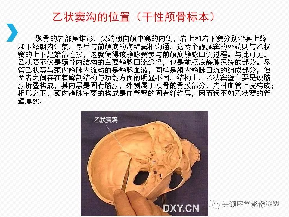 影像PPT - 【PPT】乙状窦憩室再认识-26