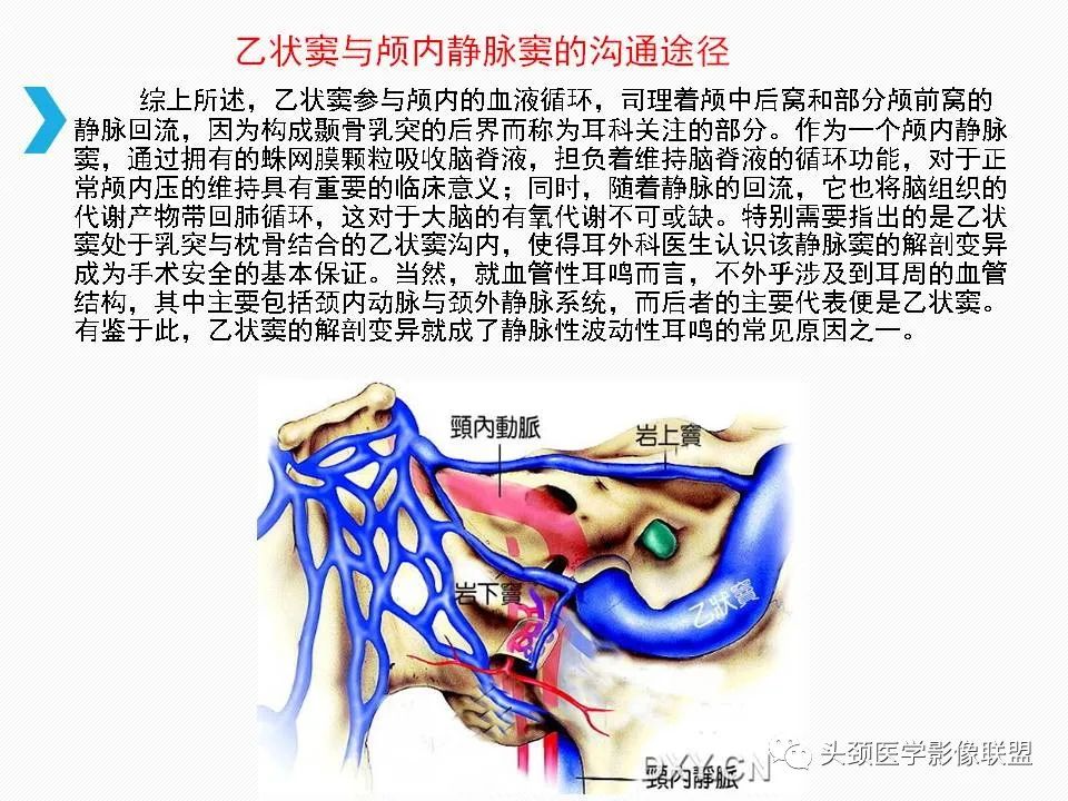 影像PPT - 【PPT】乙状窦憩室再认识-28