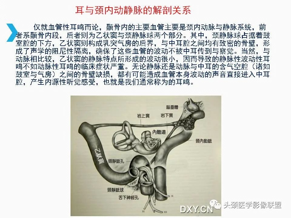 影像PPT - 【PPT】乙状窦憩室再认识-29