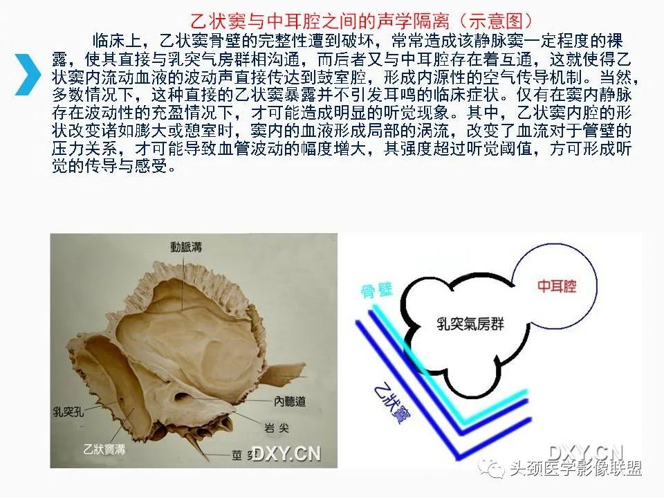 影像PPT - 【PPT】乙状窦憩室再认识-30