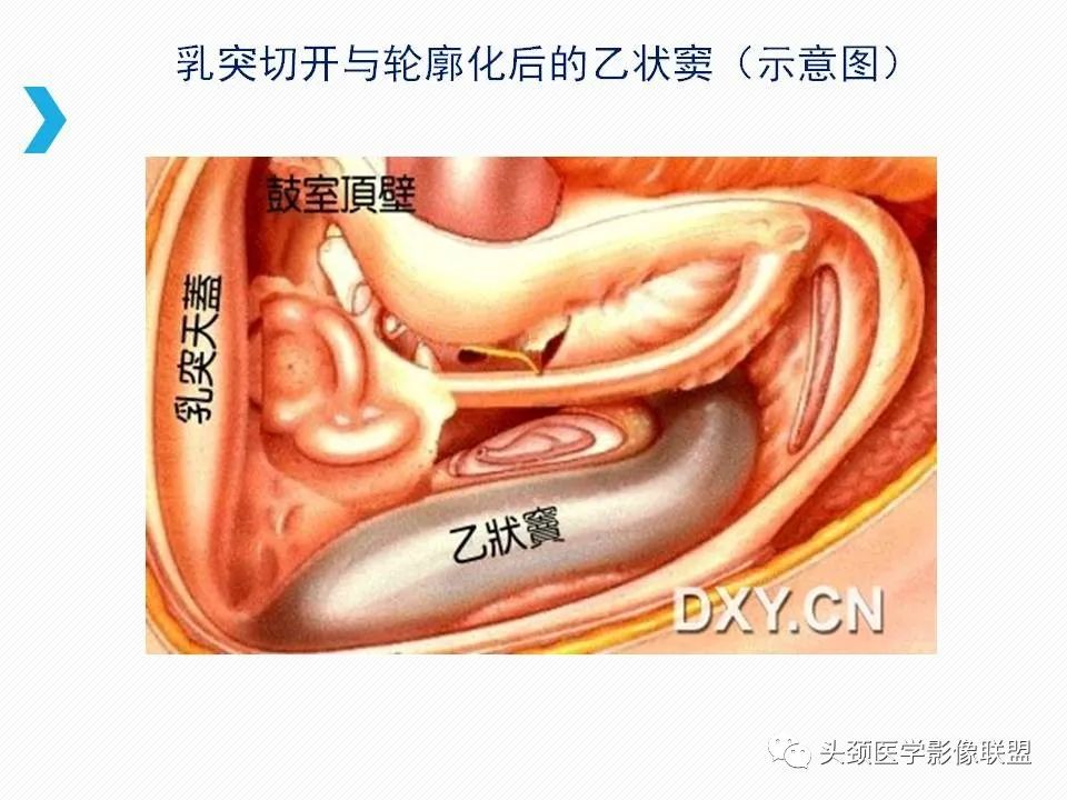 影像PPT - 【PPT】乙状窦憩室再认识-31