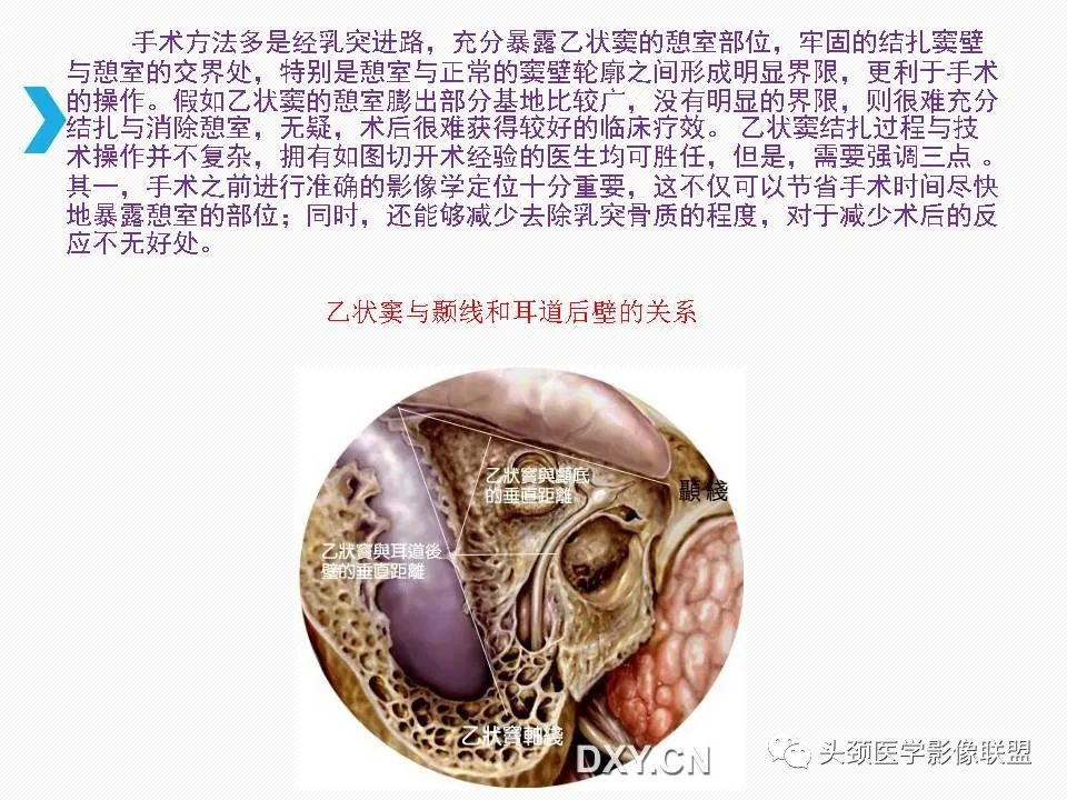影像PPT - 【PPT】乙状窦憩室再认识-37