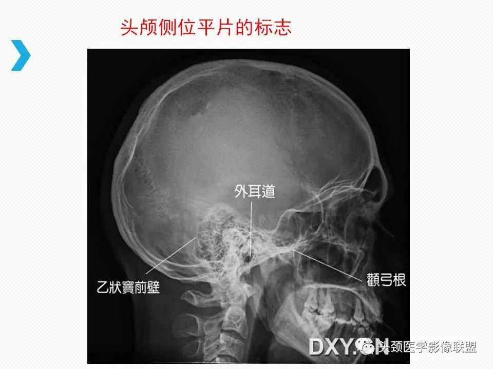 影像PPT - 【PPT】乙状窦憩室再认识-38