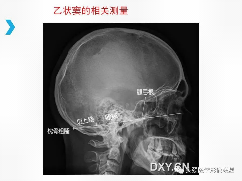 影像PPT - 【PPT】乙状窦憩室再认识-39