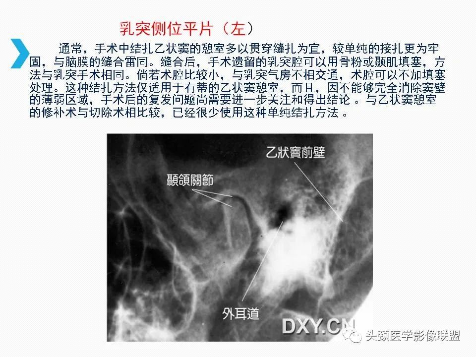 影像PPT - 【PPT】乙状窦憩室再认识-40