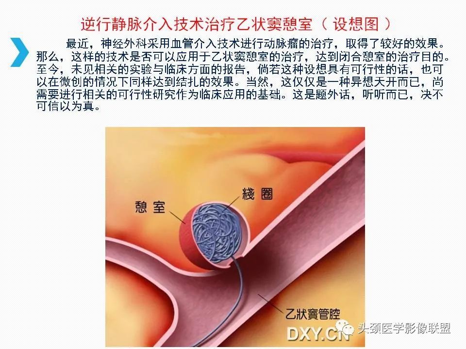 影像PPT - 【PPT】乙状窦憩室再认识-41