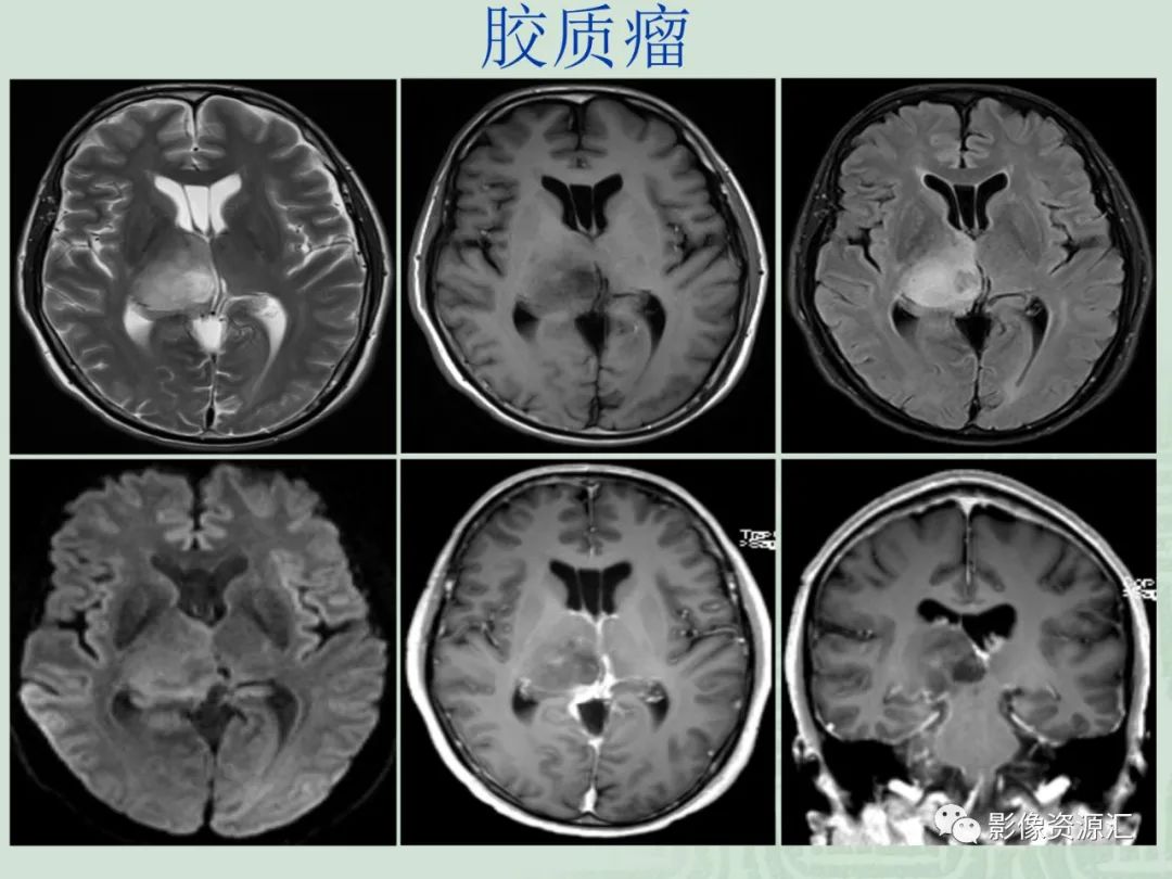 影像PPT - 【PPT】MRI灌注成像在脑肿瘤诊断中的应用价值-17