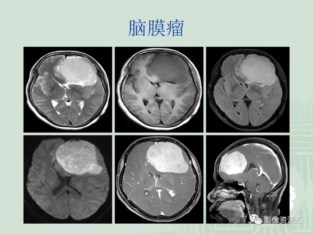 影像PPT - 【PPT】MRI灌注成像在脑肿瘤诊断中的应用价值-20