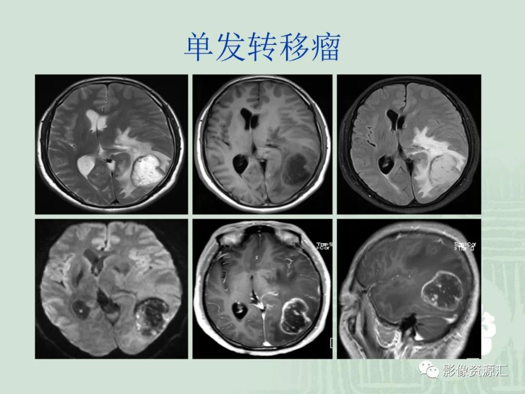 影像PPT - 【PPT】MRI灌注成像在脑肿瘤诊断中的应用价值-27