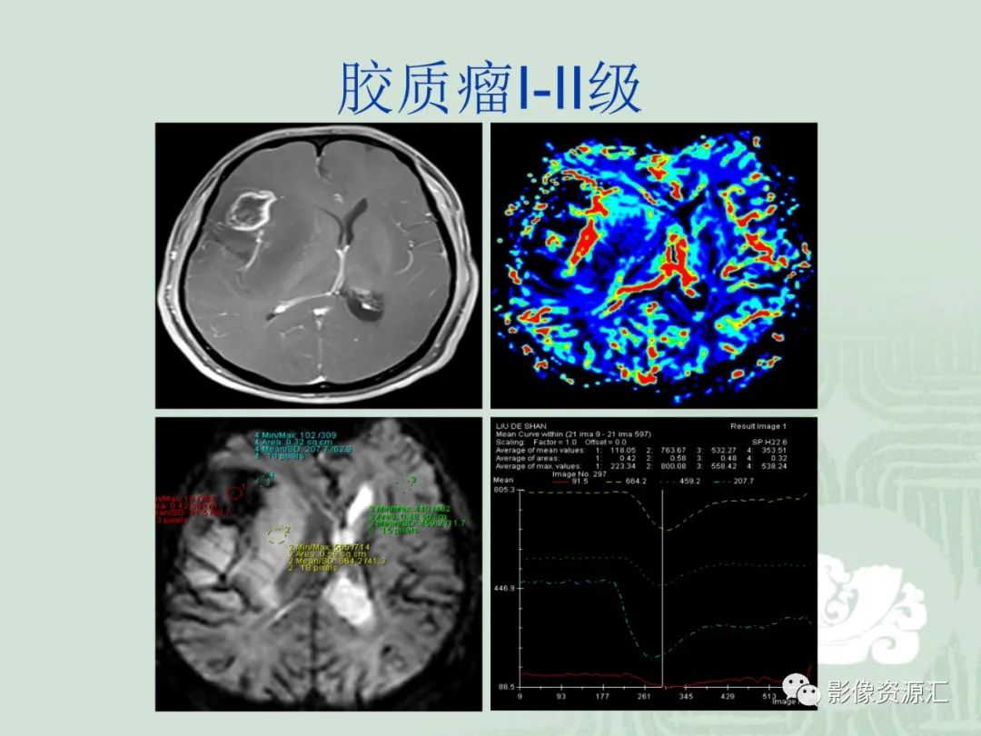 影像PPT - 【PPT】MRI灌注成像在脑肿瘤诊断中的应用价值-29