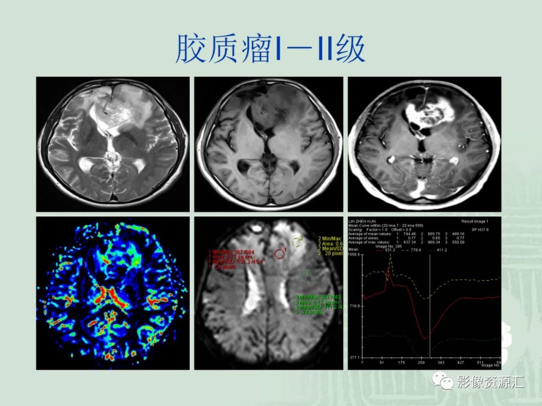 影像PPT - 【PPT】MRI灌注成像在脑肿瘤诊断中的应用价值-36