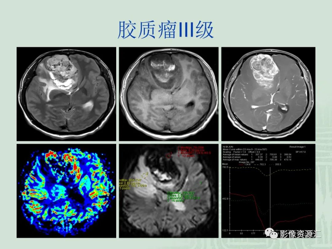 影像PPT - 【PPT】MRI灌注成像在脑肿瘤诊断中的应用价值-37