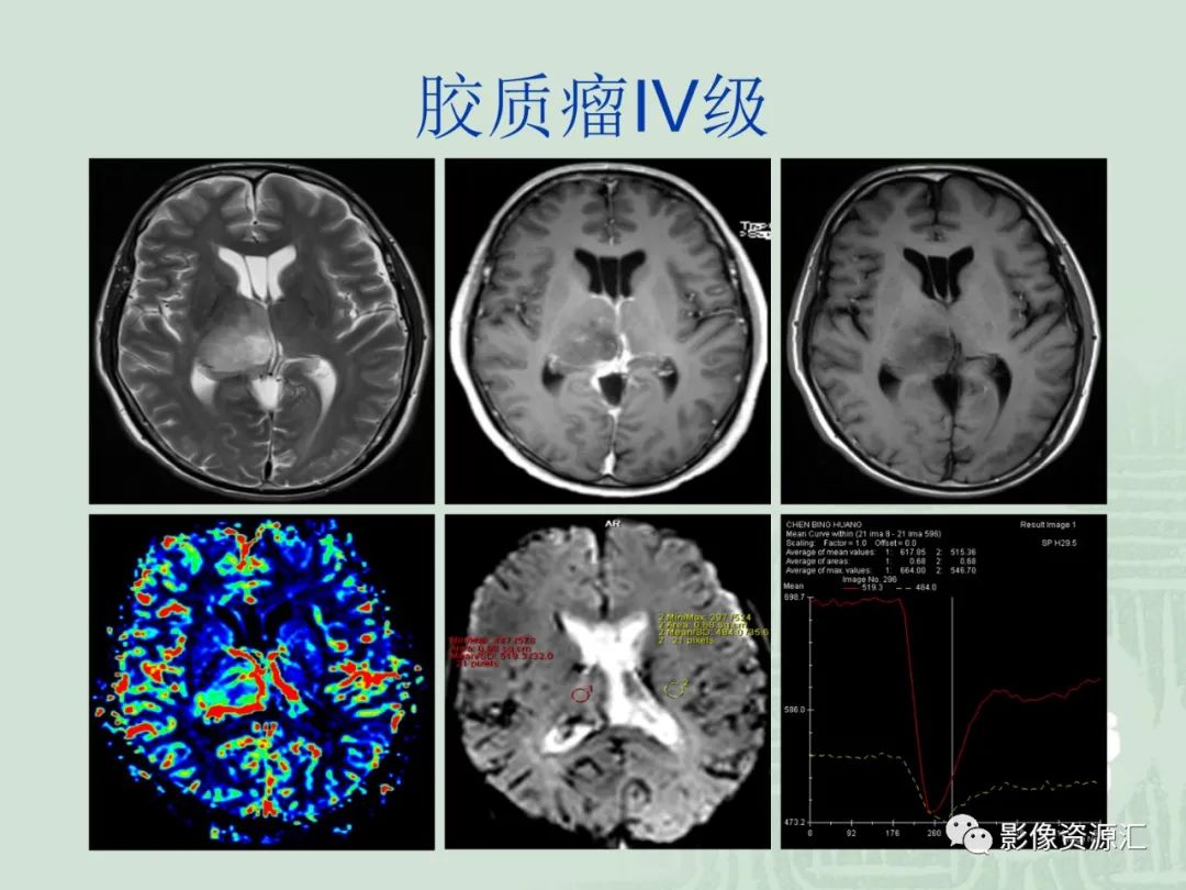 影像PPT - 【PPT】MRI灌注成像在脑肿瘤诊断中的应用价值-38