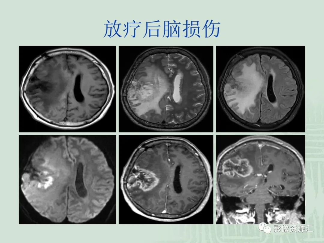 影像PPT - 【PPT】MRI灌注成像在脑肿瘤诊断中的应用价值-43