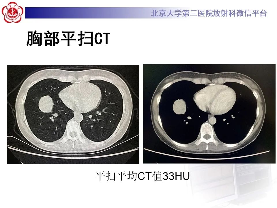 影像PPT - 【PPT】肺粘液表皮样癌-3